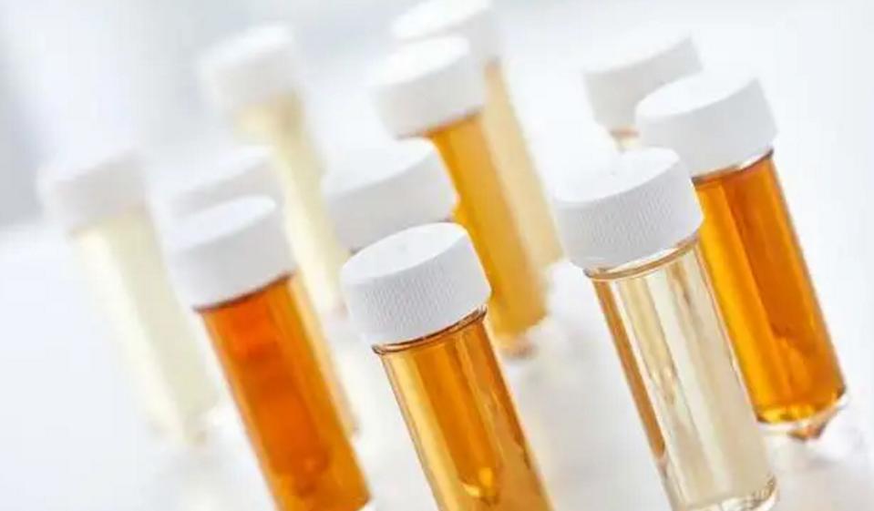 小便泡沫多和肾有什么关系,尿尿泡沫多是肾阴虚还是肾阳虚