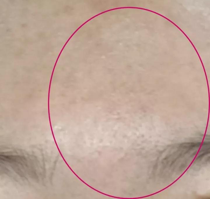 第一次打水光针爆痘,第一次打水光针反黑了