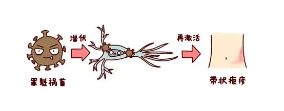 医生科普带状疱疹的预防及治疗,有一种痛叫带状疱疹