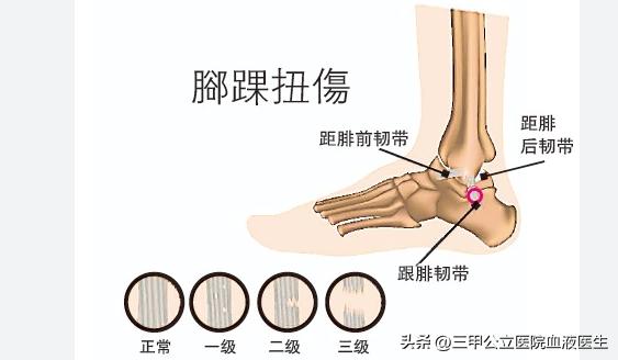 内马尔脚踝90度扭曲治疗,内马尔脚踝90度扭曲拉莫斯