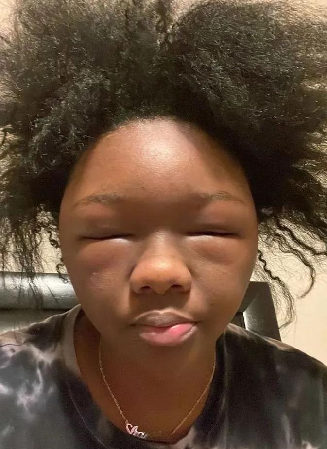 美国妹子染头发过敏全脸肿成emoji，不光失明还险些窒息