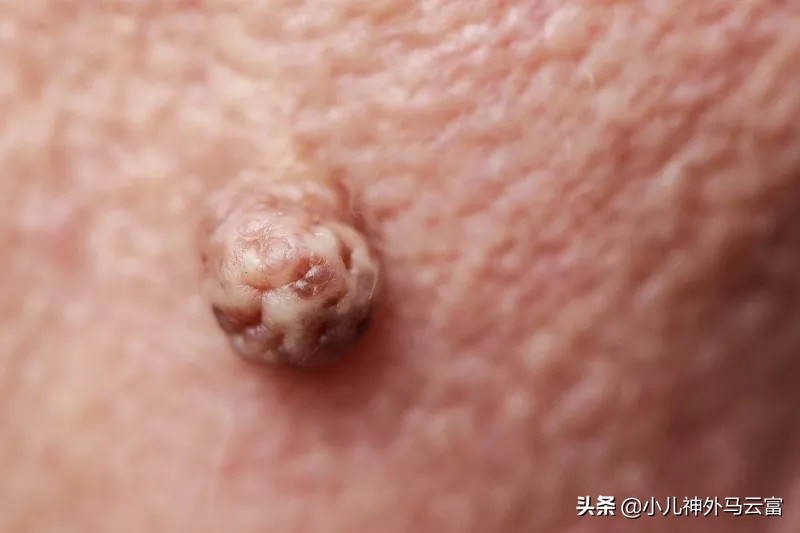 脖子和腋下的小肉粒,脖子和腋窝长小肉粒怎么回事