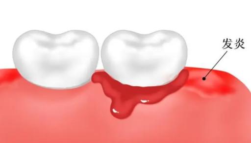 补过的牙可以用电动牙刷吗,补过牙用电动牙刷选什么模式