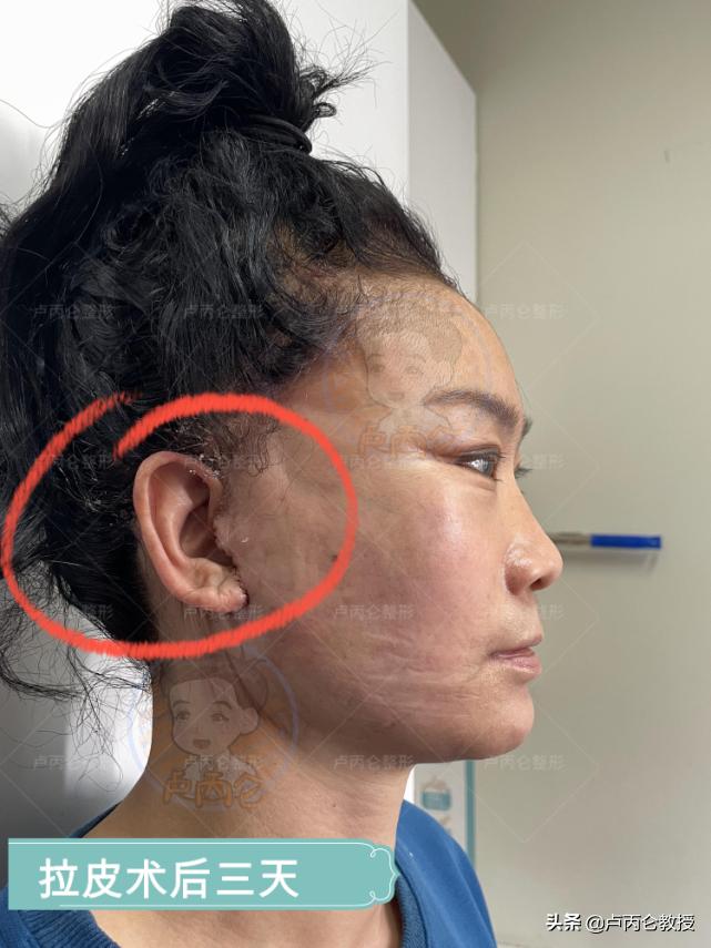 拉皮除皱手术有哪些,拉皮除皱手术的危害