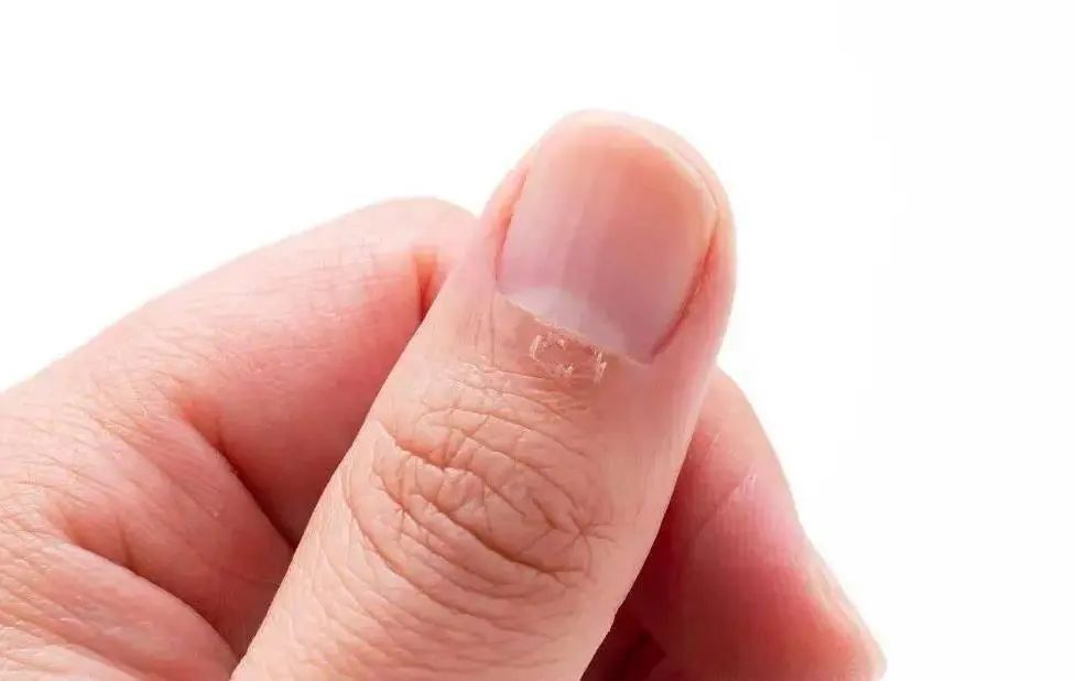 手指上长出了倒刺,要小心,不要随意乱拔,注意方式