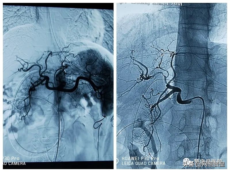 胃窦癌微创切除手术,胃窦癌根治切除术