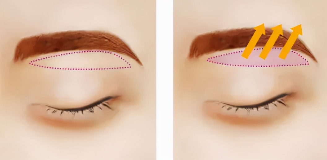 下眼皮下垂松弛如何紧致,60岁上眼皮松弛下垂可以手术割吗