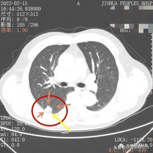 肺腺癌高危亚型什么意思,肺腺癌高危亚型