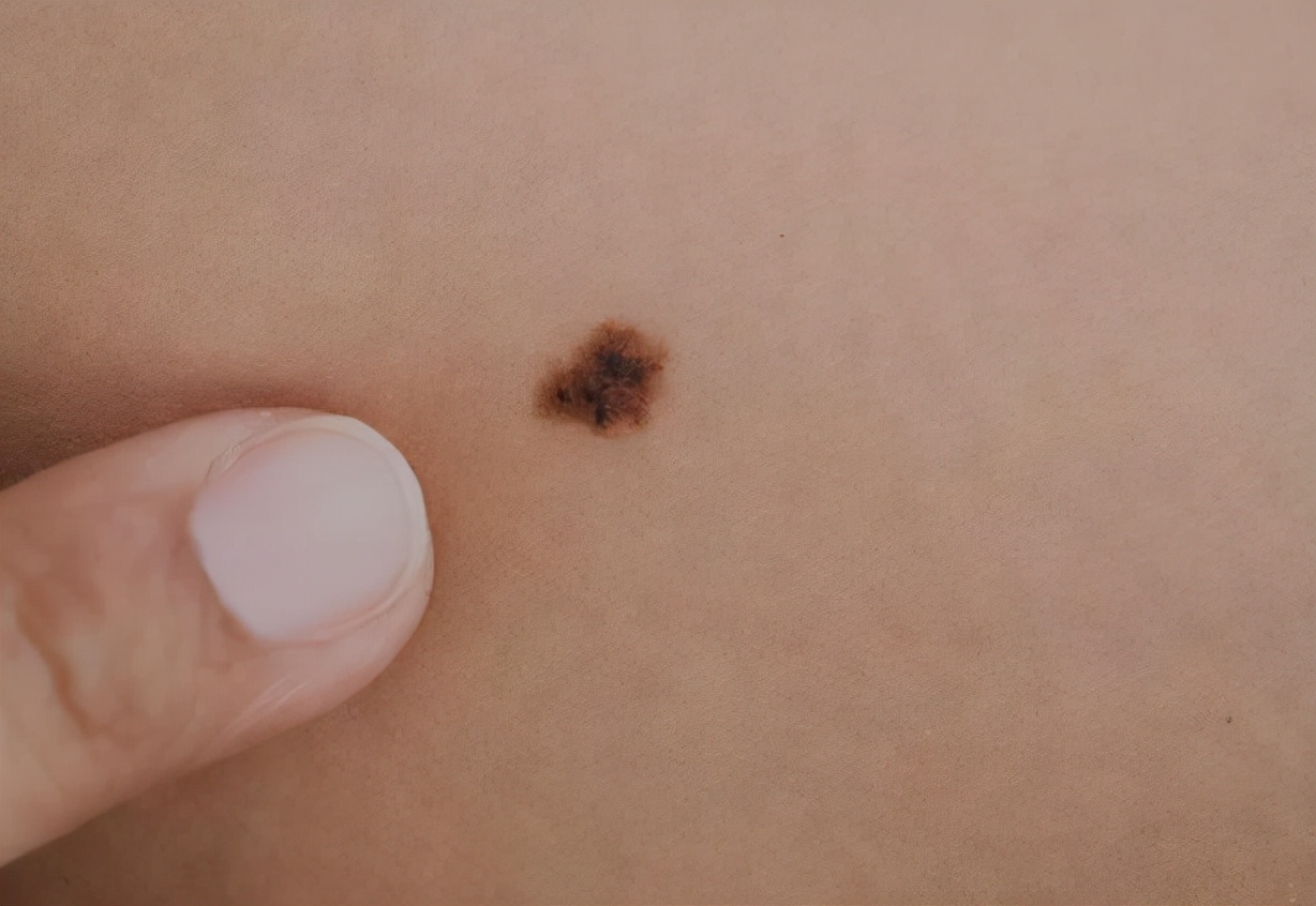 怎么在医院确定黑痣是不是良性的,黑痣隆起挂什么科检查