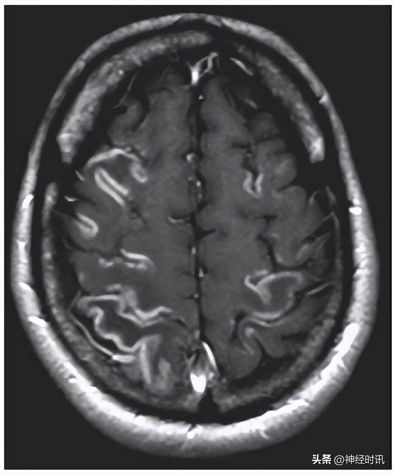 缺血缺氧性脑病小孩长大后会怎样,中度缺氧缺血性脑病会留后遗症吗
