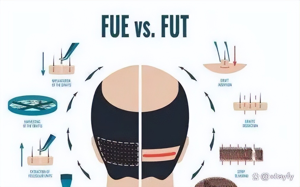 植发前先来算算植发该花多少钱,植发一般花多少钱就够了