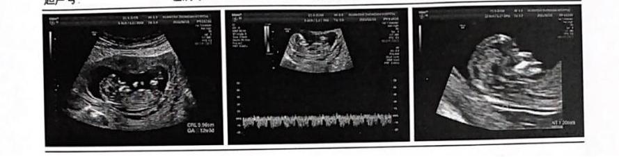 怀孕13周决定放弃,怀孕13周胎儿必须打掉吗