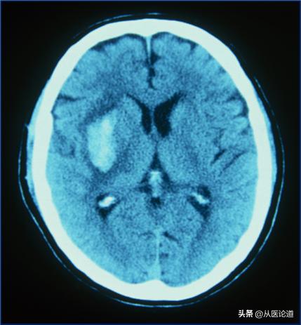 皮肤出现紫癜瘀点瘀斑,血小板减少性紫癜瘀斑