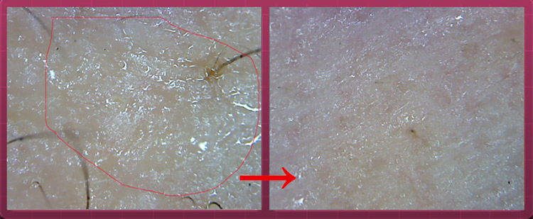 清洁面膜可以去黑头粉刺闭口吗,清洁面膜可以去除黑头吗