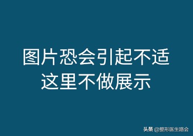 三甲医院鼻整形医生,鼻子整形医生科普类视频