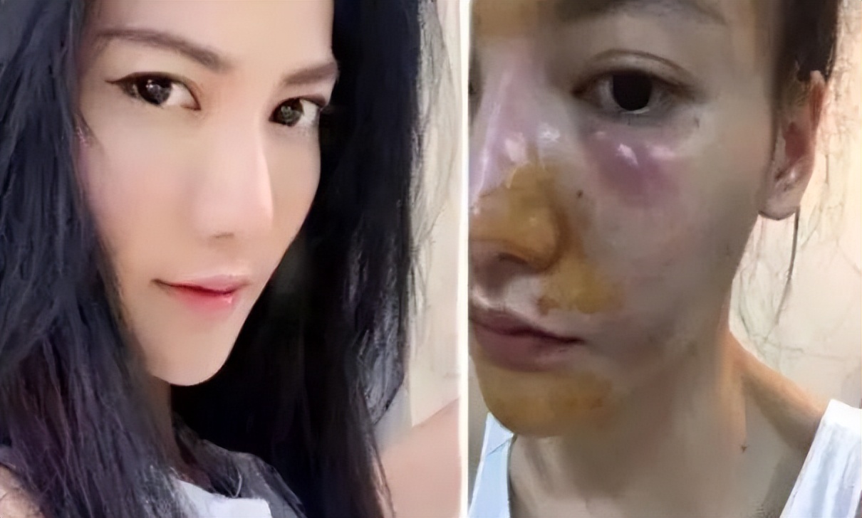 泰国女子打6年美白针六胜肽,女子打美白针后身患多病