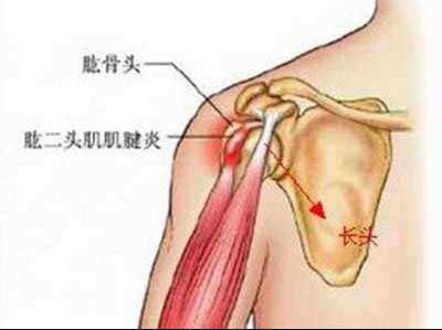 肱二头肌长头肌滑脱,肱二头肌长头肌腱滑脱