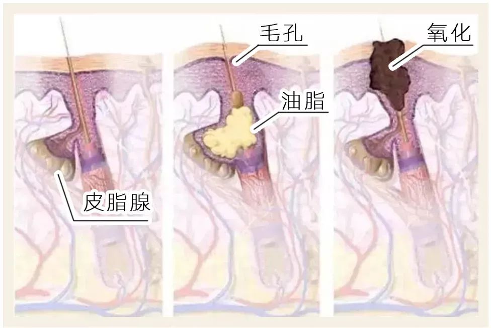 怎样才能彻底跟黑头说拜拜呢,科普如何让烦人的黑头消失