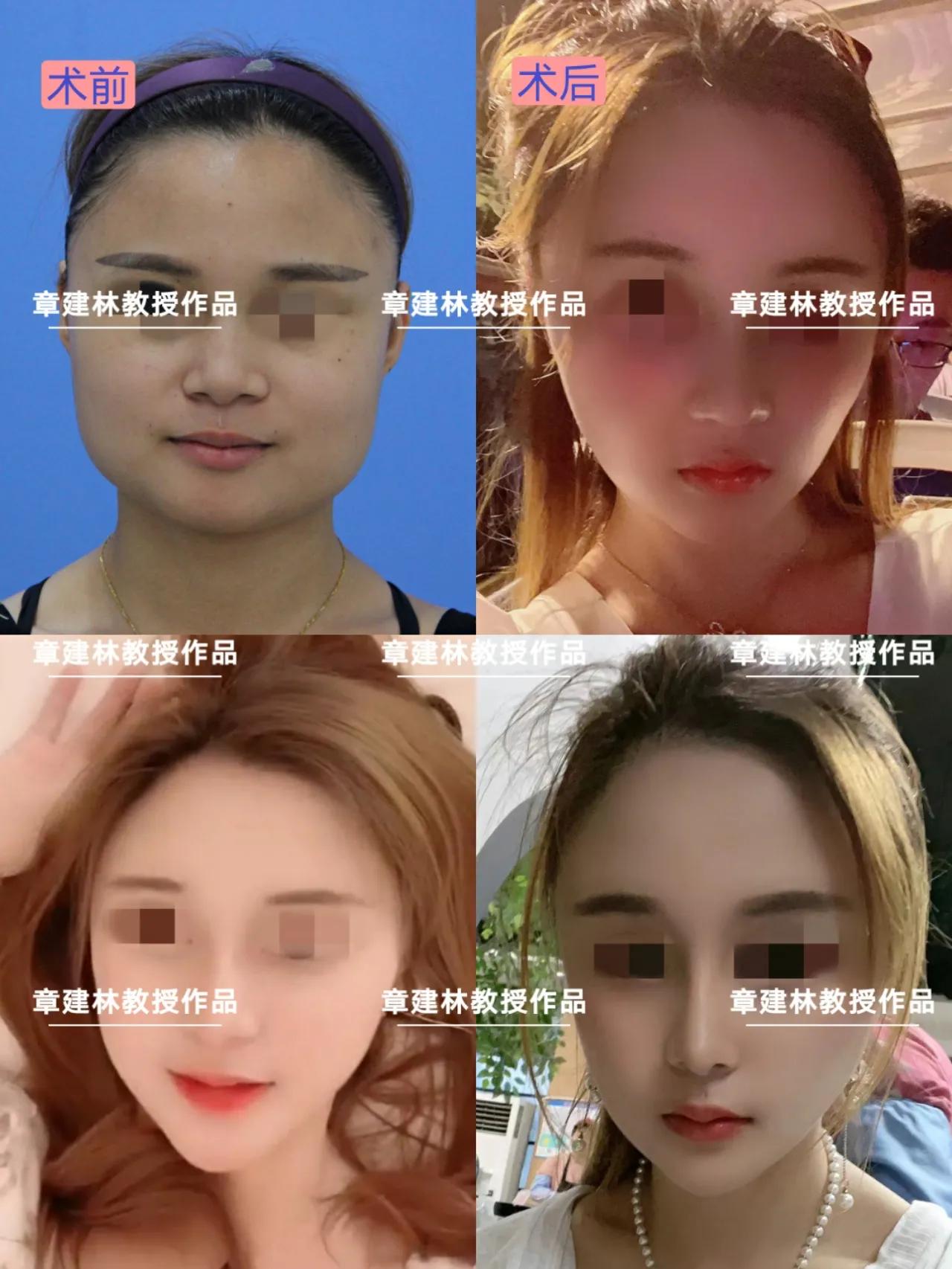 做下颌角有无年龄限制,四十岁还适合做颧骨手术吗