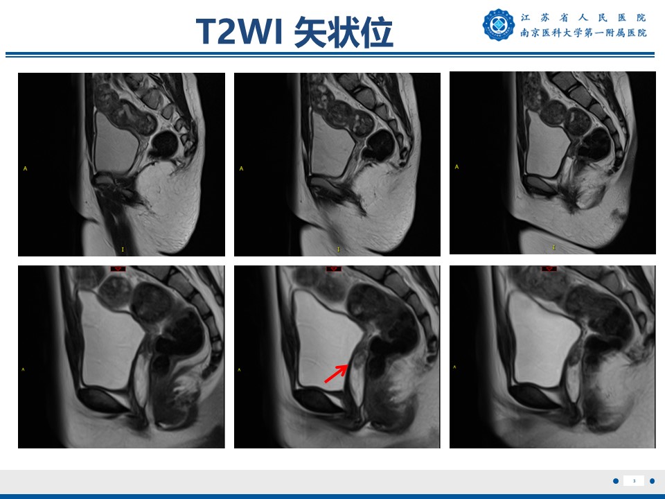 好文分享——《胚胎型横纹肌肉瘤》