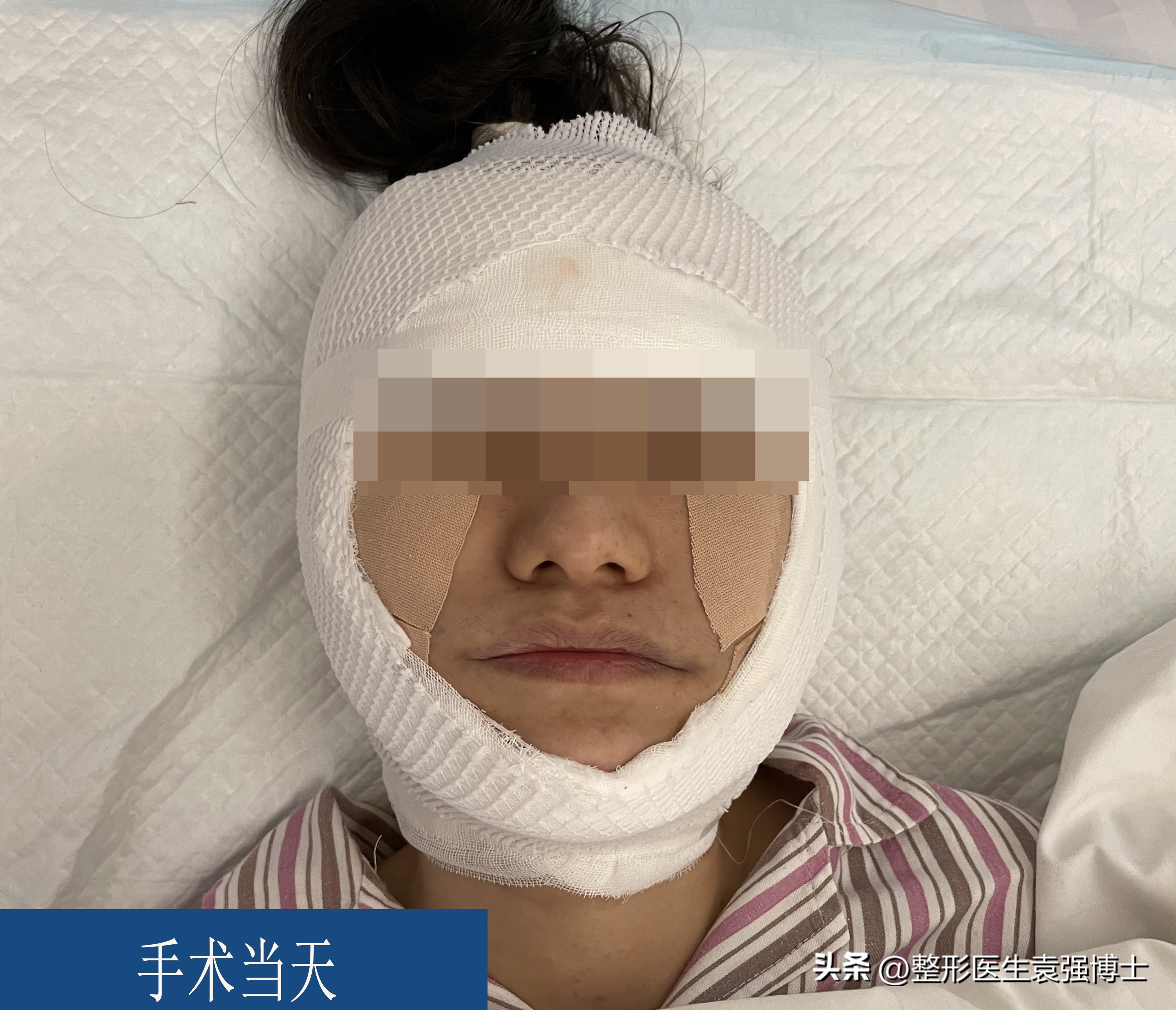 做拉皮恢复期太难熬,拉皮手术的十大问题