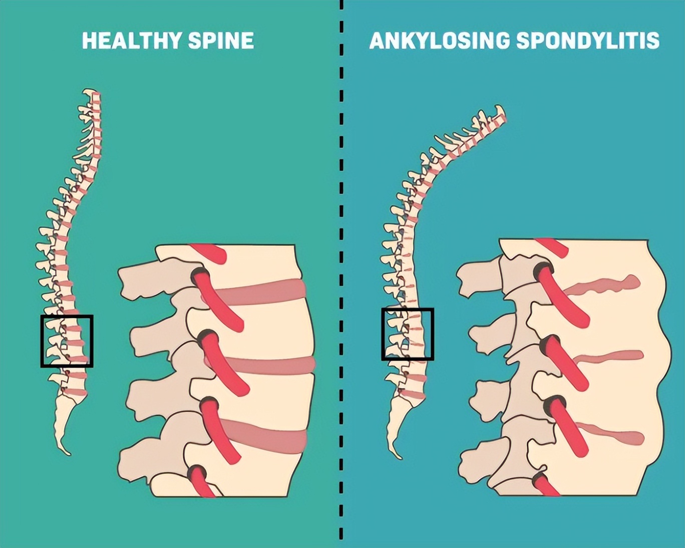 治疗强直性脊柱炎必须按体质治吗,针对强直性脊柱炎最好的锻炼方法