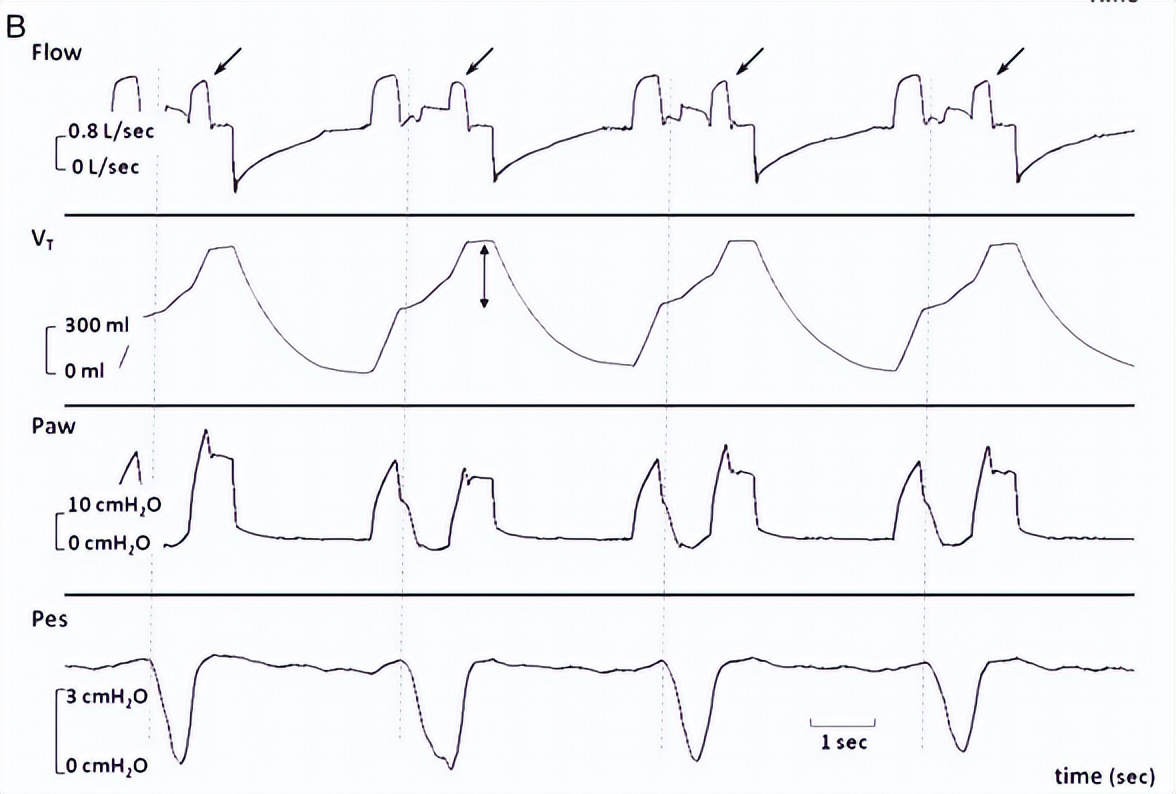 罗红教授,机械通气波形分析和临床应用