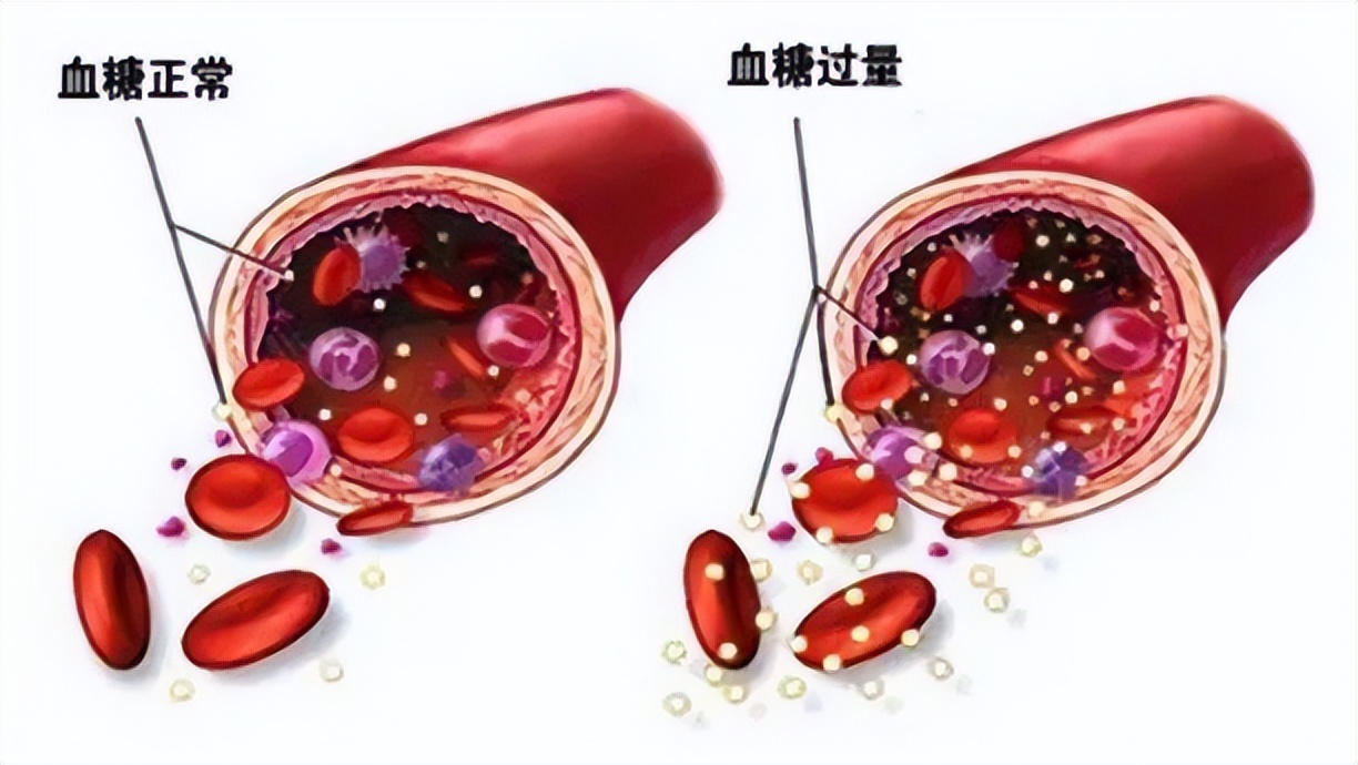 血糖糖化控制在6,血糖控制在多少糖化才会达标