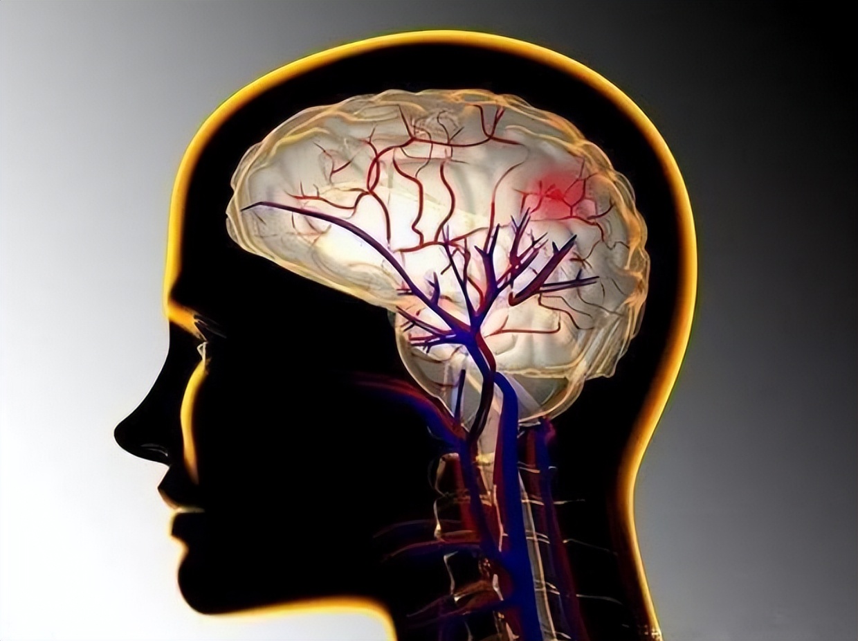 痰瘀阻络型中风偏瘫吃什么中成药,治疗脑卒中的方子