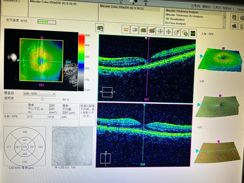 激光视力矫正危害,警惕激光笔对眼睛的损伤