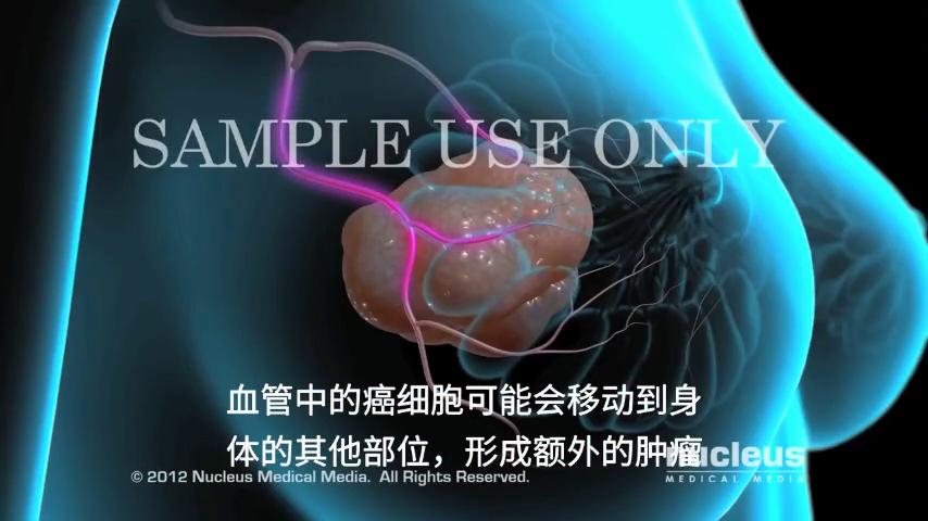 肺部鳞状肿瘤靶向治疗,什么是肿瘤靶向治疗