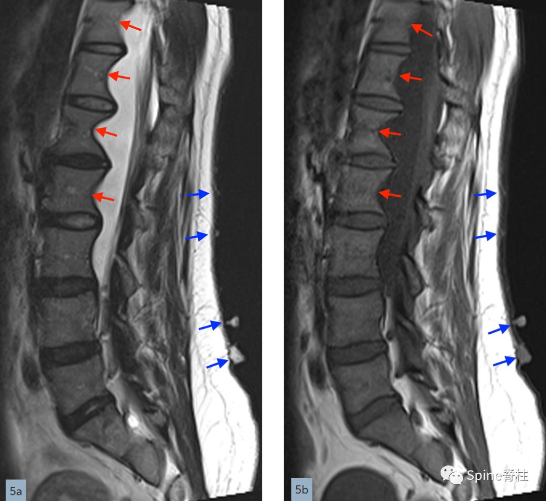 硬膜扩张,duralectasia