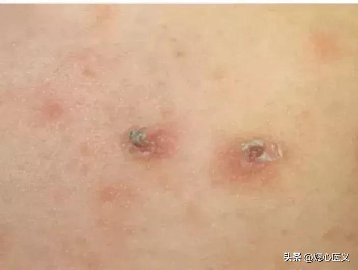 皮肤病疥疮是什么症状,疥疮被传染的最初症状