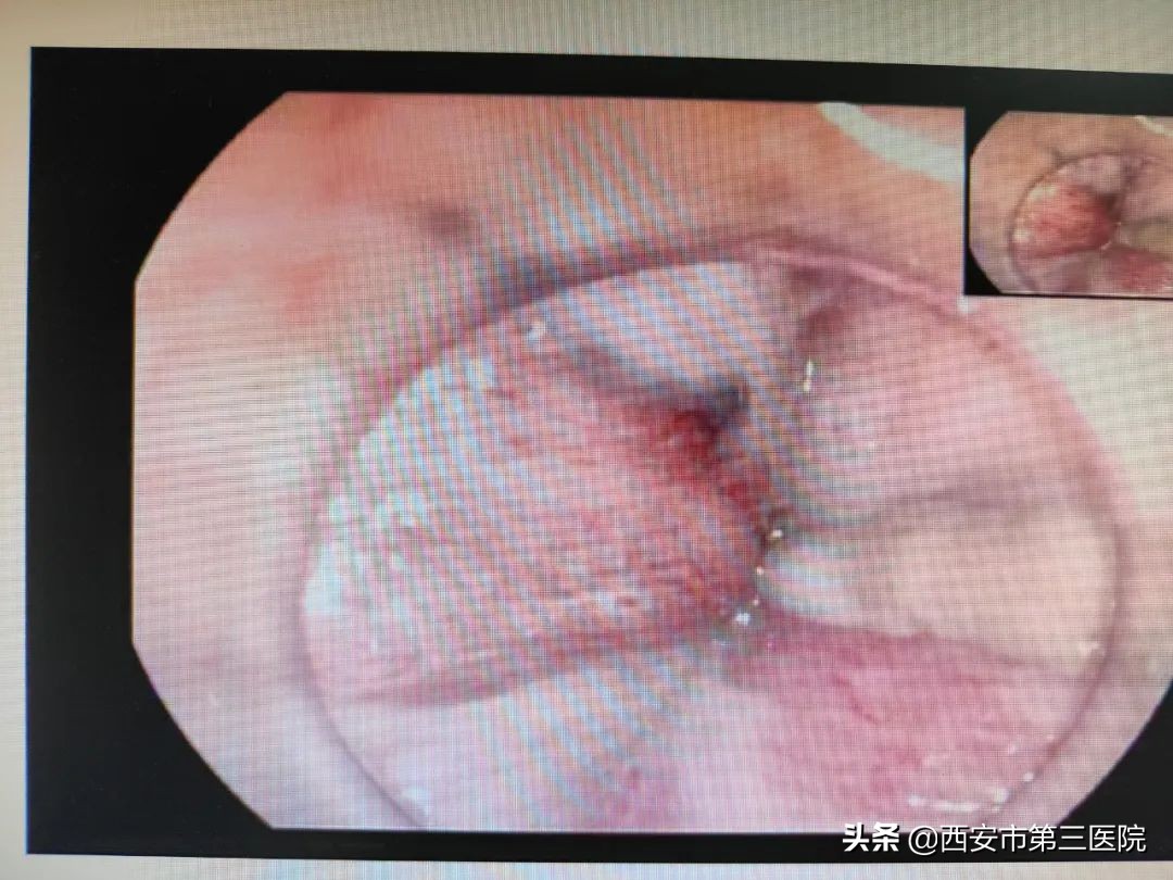 内痔出血多会导致贫血吗,内痔出血伴有贫血怎么办