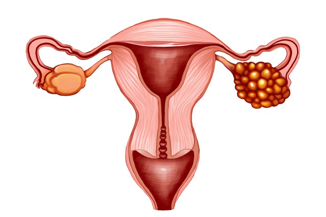卵巢癌发现就是晚期吗,卵巢癌一发现就是晚期