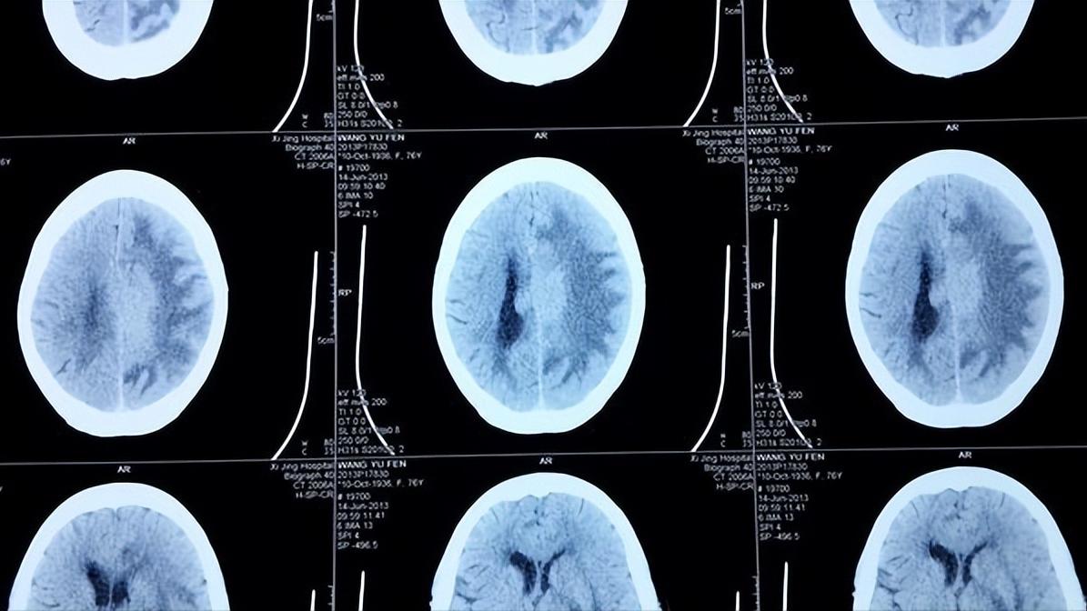 罕见恶性肿瘤肉瘤科普,软组织恶性肉瘤是癌症吗