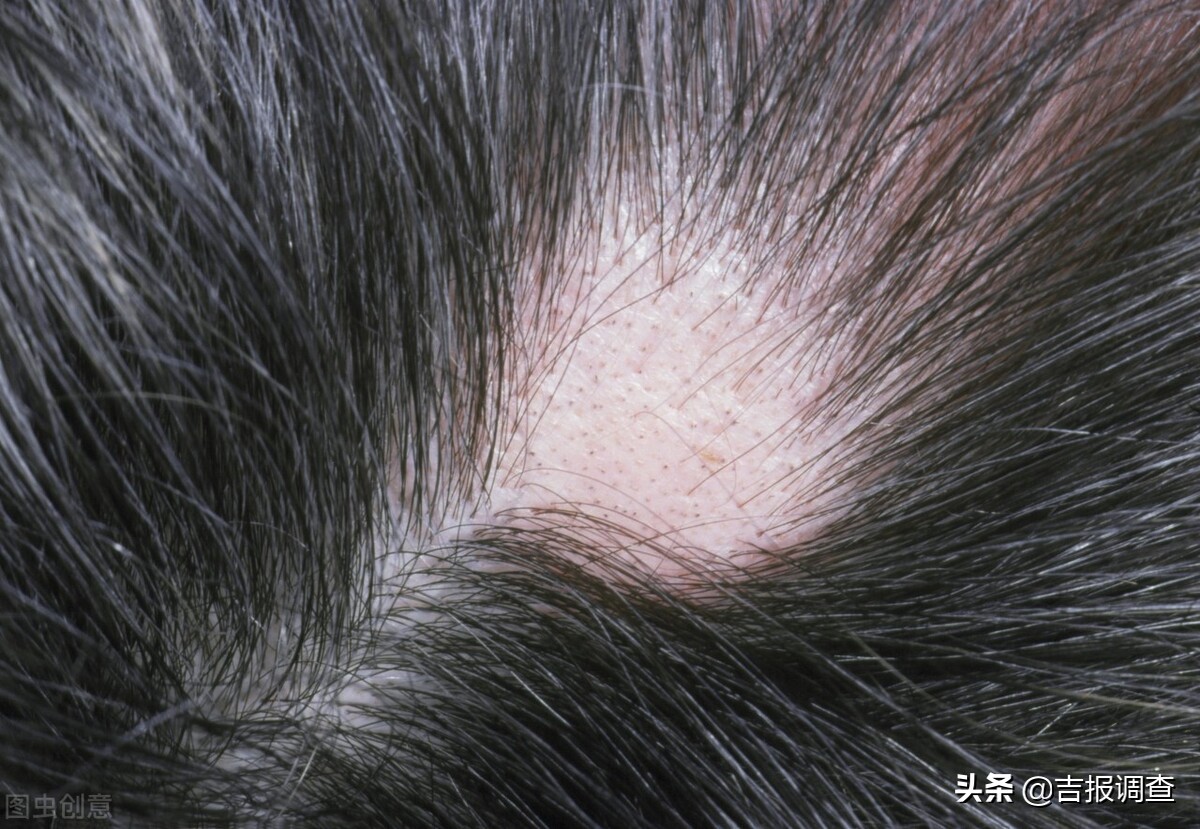 脱发严重自然卷发际线高,脂溢性脱发即雄激素性脱发