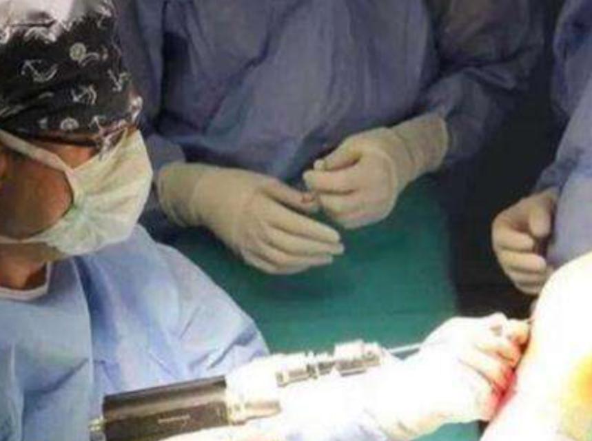 李亚诺中国断骨增高第一人,当年花16万断腿增高