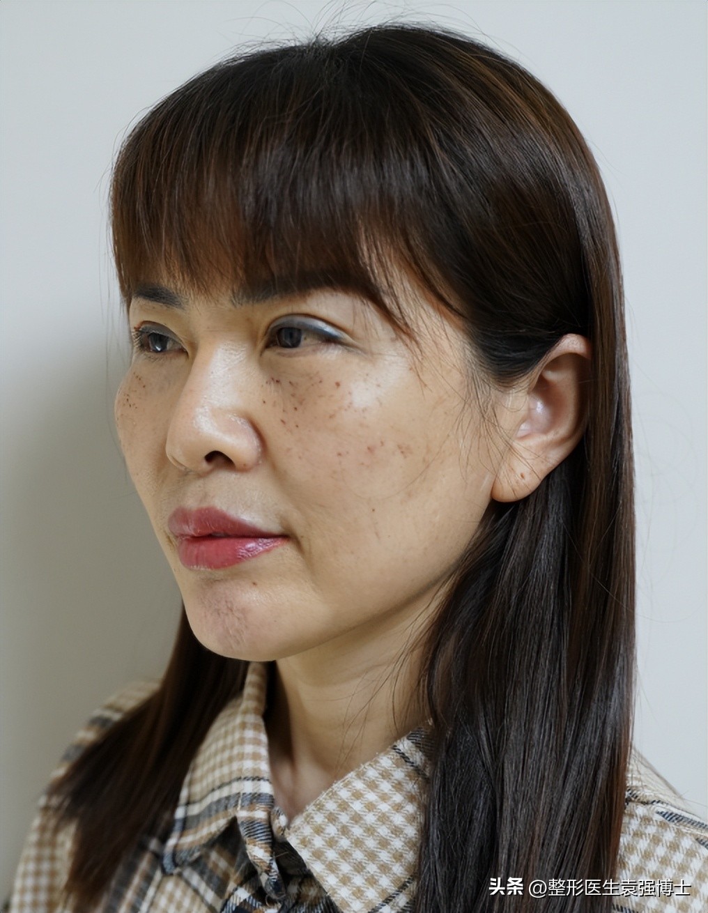 北京做大拉皮前后对比照片图文,面部做大拉皮提升的真实案例