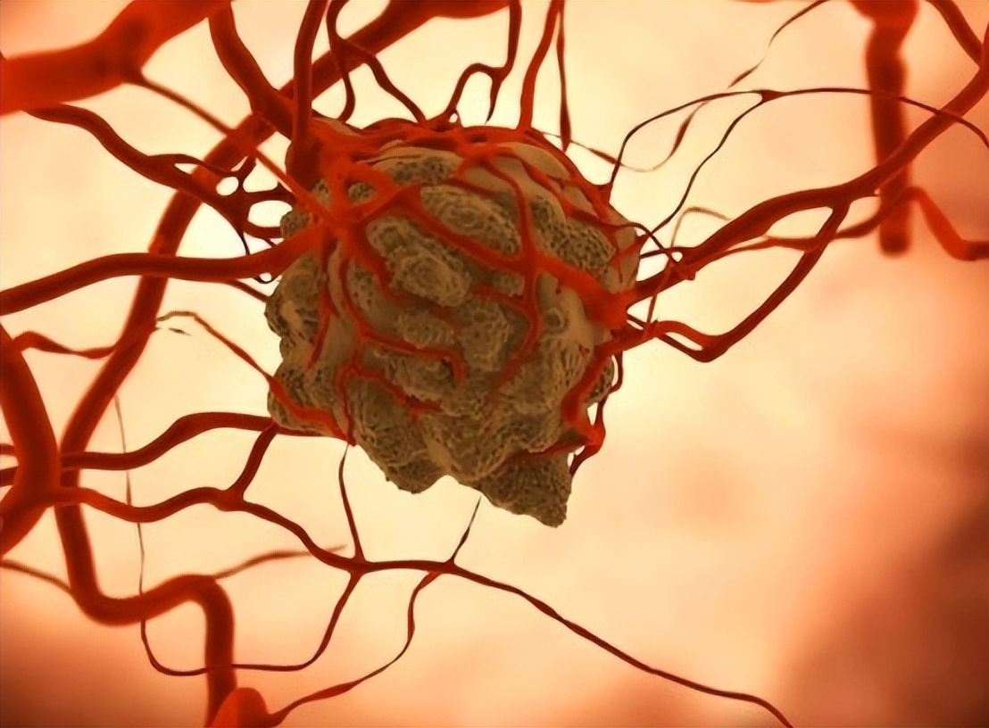 牙龈纤维瘤是肿瘤吗,牙龈纤维瘤会遗传给下一代吗