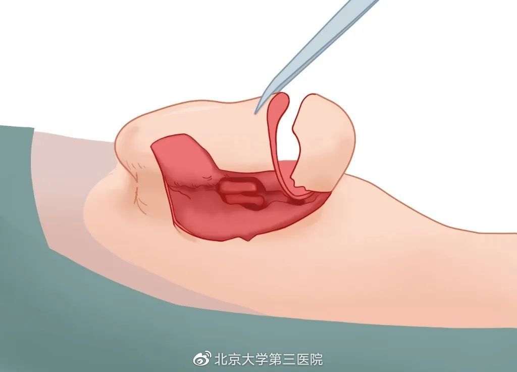 意外留疤怎么安慰,眉尾意外受伤留疤好不好