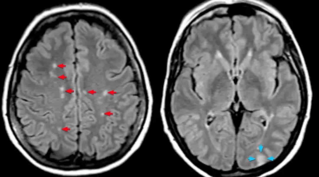 脑血管搭桥后癫痫,脑血管病后癫痫