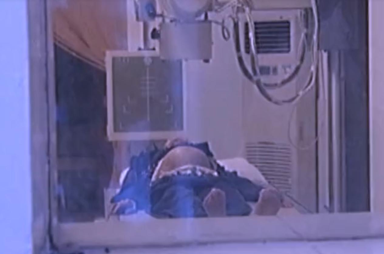 2007年四川90岁老妇，腹中怀子60年未生，后检查发现胎儿没有腐烂