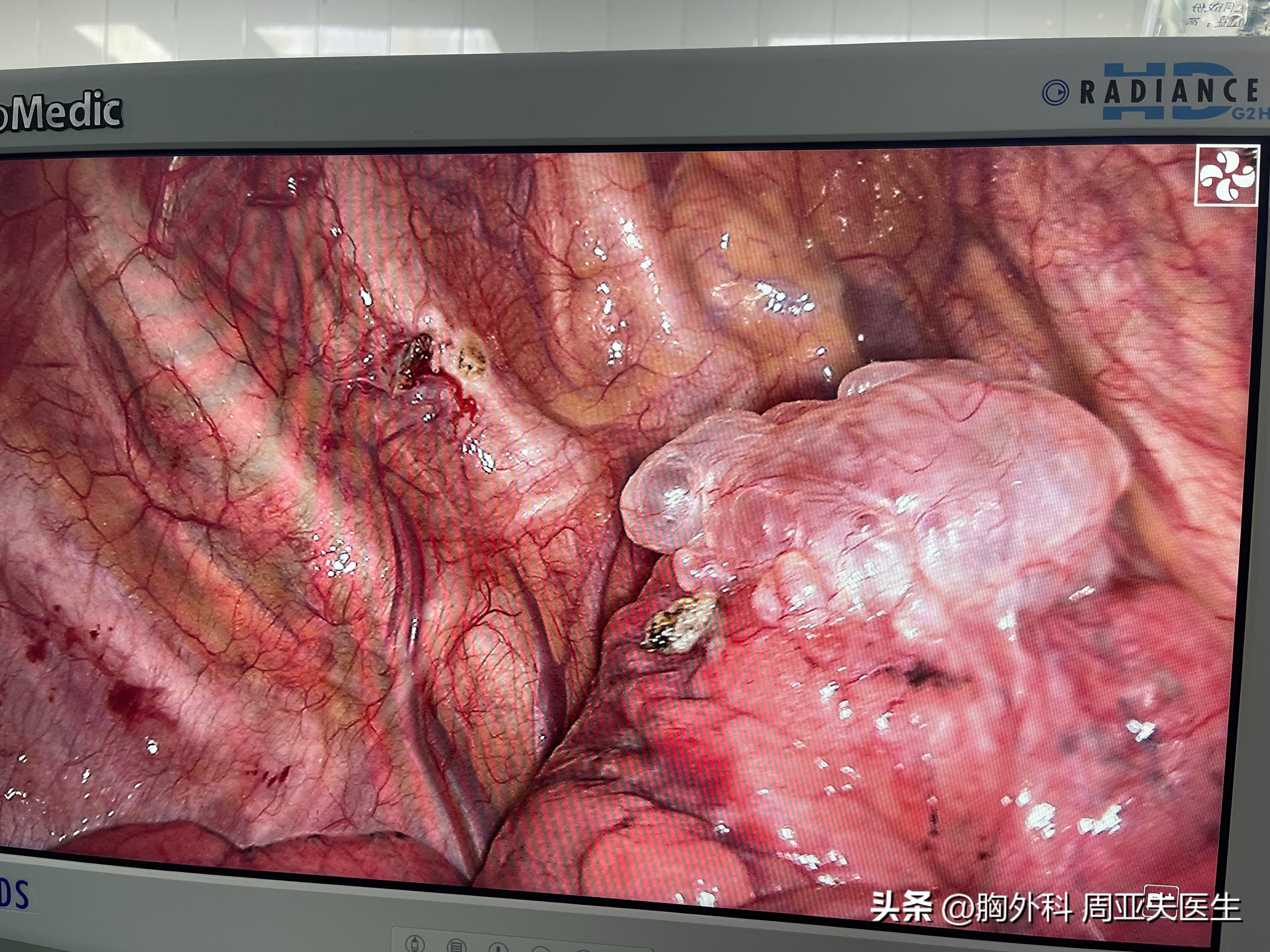 关于气胸的讨论,关于气胸