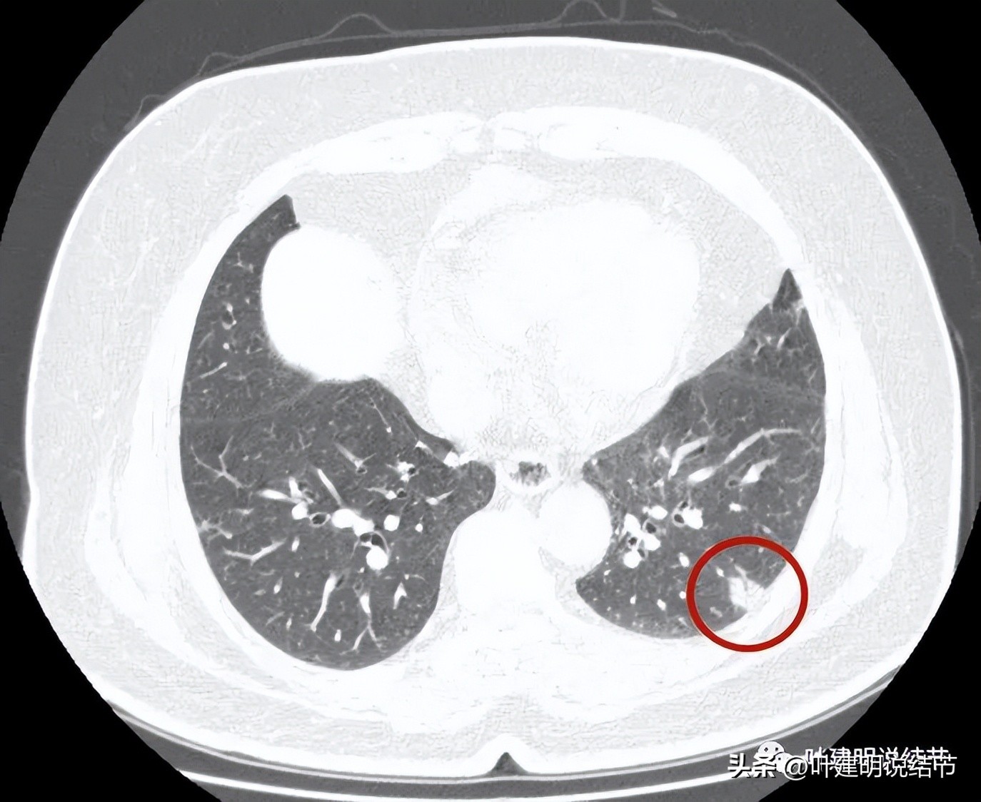 肺结节实性为什么建议抗炎治疗,肺上实性结节抗炎后变成空洞
