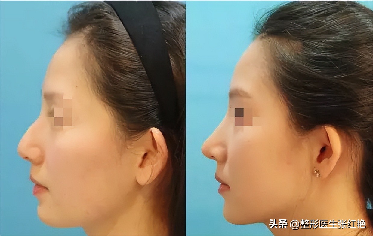 驼峰鼻的矫正八大处,河南驼峰鼻矫正大约费用是多少