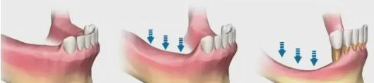 缺牙后，如何防止牙槽骨吸收？专家给出3个有效办法