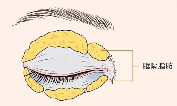 眼袋纹是怎么形成的原因,眼袋的形成原因及消除方法