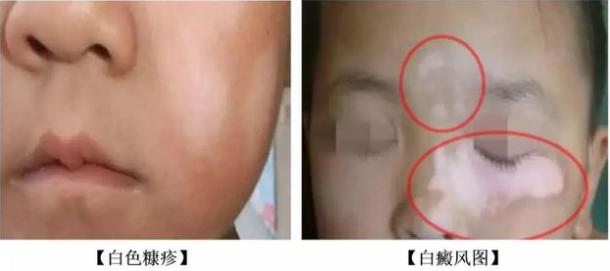 小孩子脸上长白斑需要吃打虫药吗,孩子脸上长斑是该打虫子了吗