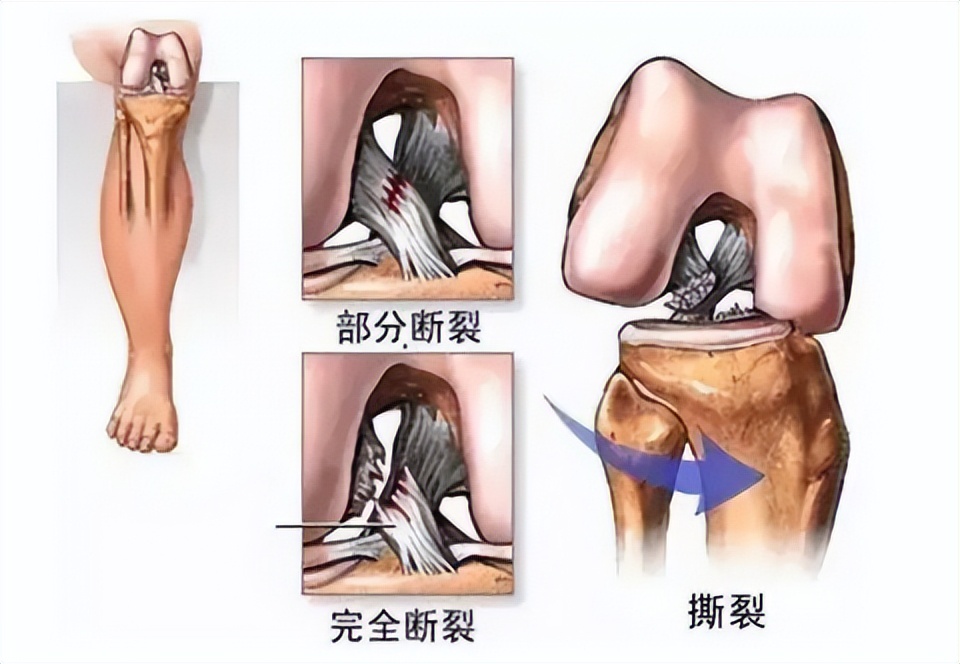 韧带断裂微创手术能恢复正常吗,打篮球韧带断裂做手术多少钱